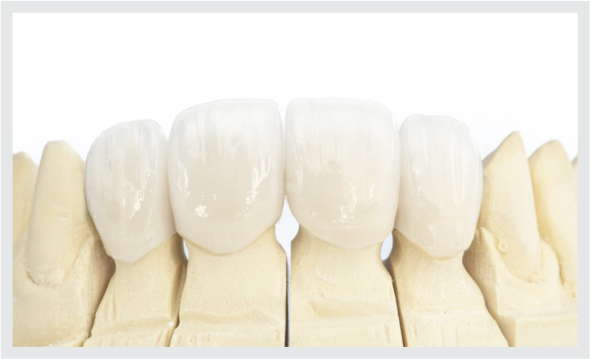 Imagem do produto final cerômero - dente - laboratório de prótese Kurdian